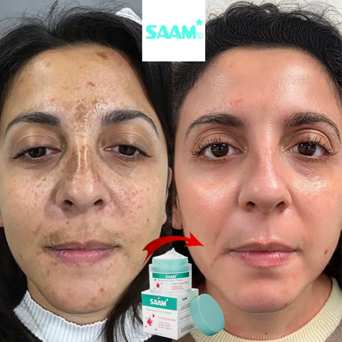 SAAM Face Cream for Melasma, Freckles & Dark Spots