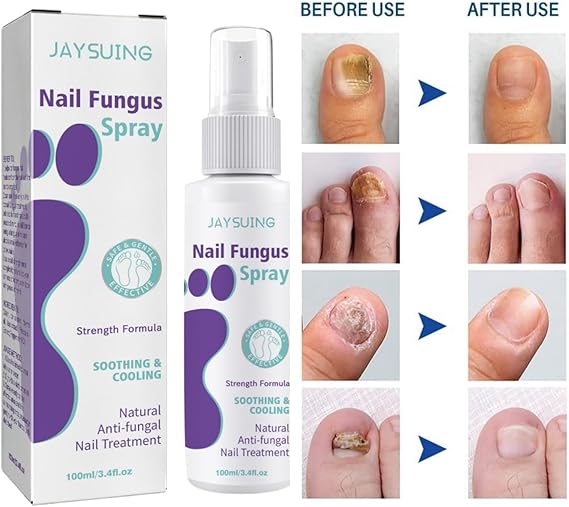 JAYSUING Nail Fungus Spray
