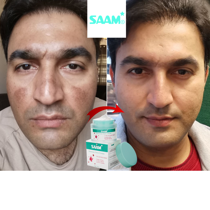 SAAM Face Cream for Melasma, Freckles & Dark Spots