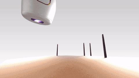 IPL LASER HAIR REMOVAL : Mini Laser Hair Removal