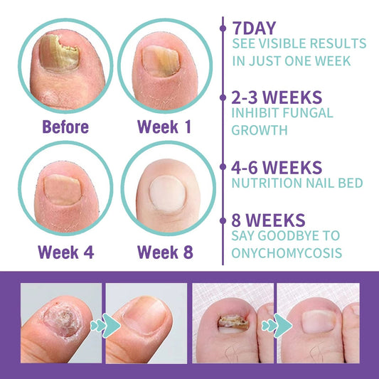 JAYSUING Nail Fungus Spray
